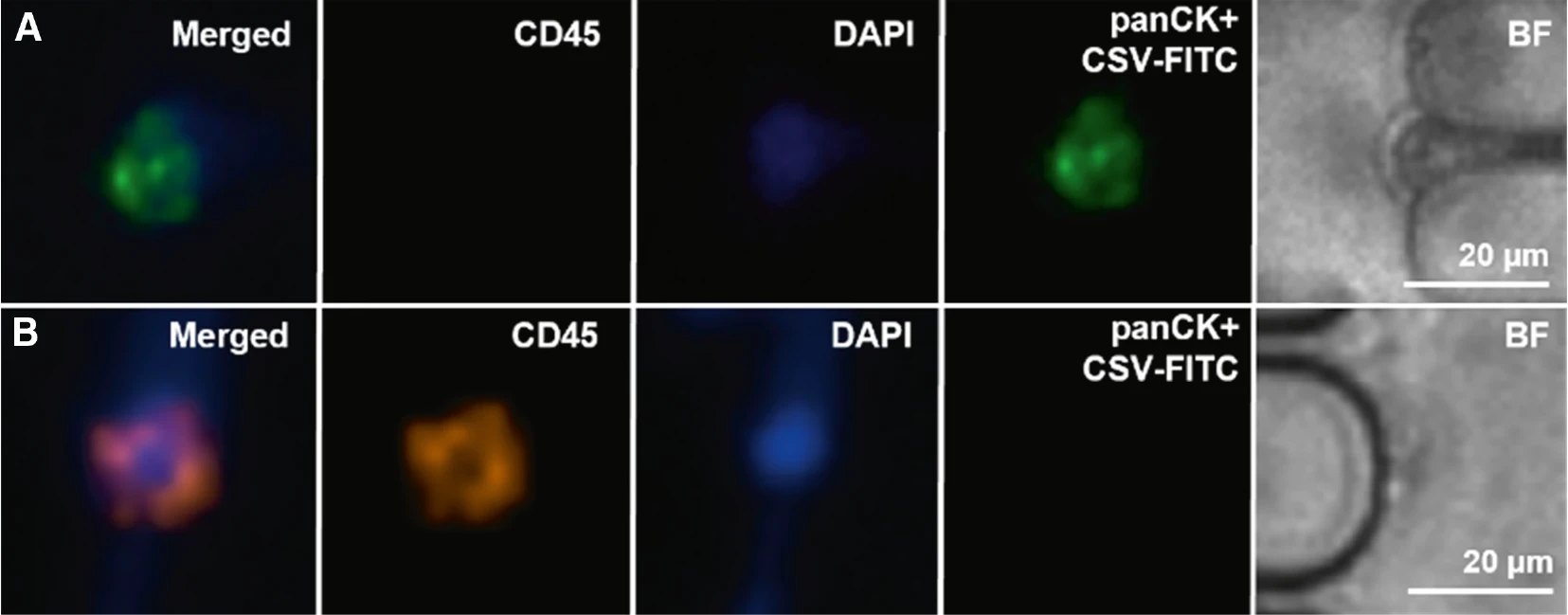 Fluorescence microscopy panels showing a captured cell positive for panCK and CSV-FITC and negative for CD45, alongside a CD45-positive leukocyte